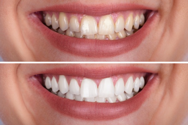 Clareamento dental na Clínica Benvenutti