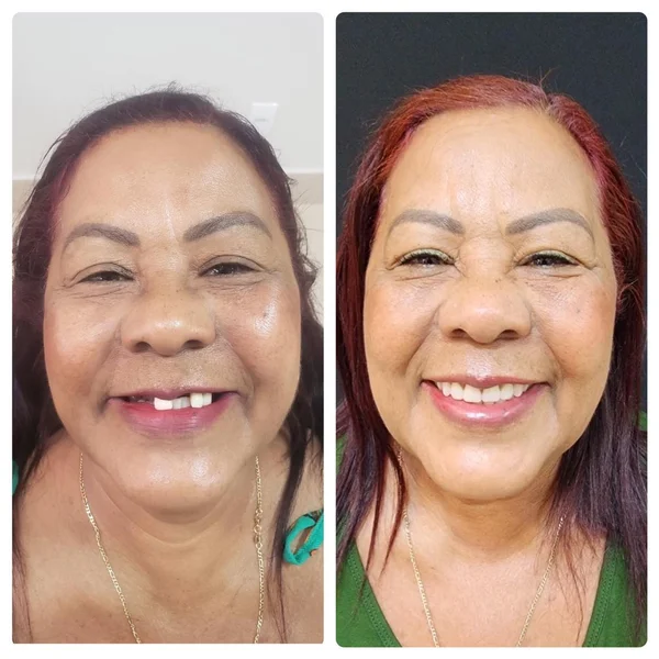 Antes e depois de implante dentário