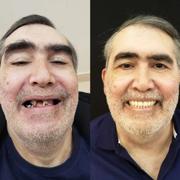 Antes e depois de implante dentário