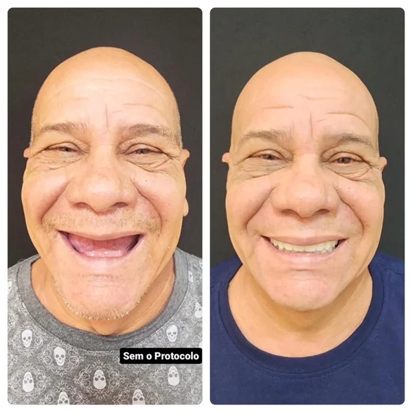 Antes e depois de implante dentário