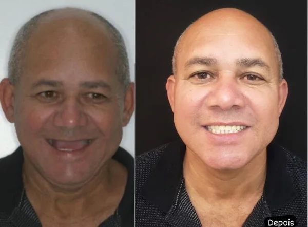 Seu Roberto, antes e depois do implante dentário