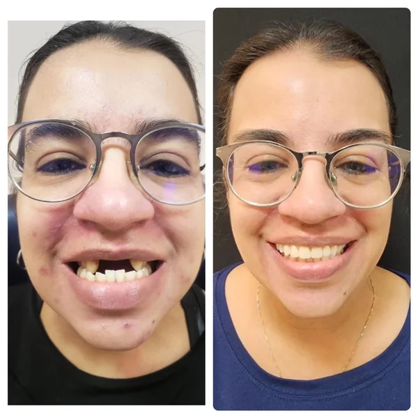 Fernanda, antes e depois do implante dentário